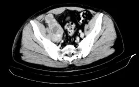 liposarcoma