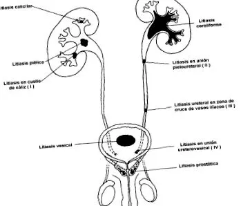 lithiasis