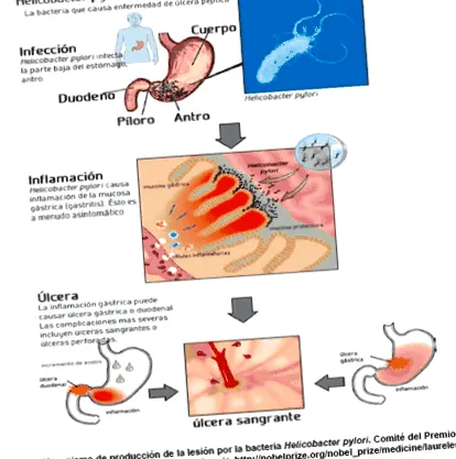 pylori бактерій