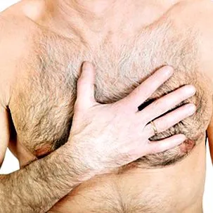 gynecomastia