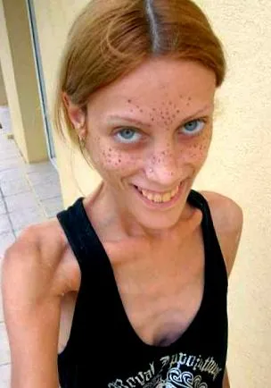 anorexia