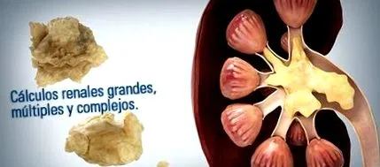 pcnl