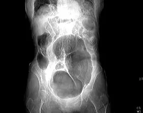 lvulus