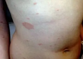 Gibert pityriasis
