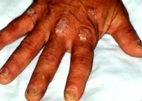 енциклопедія MedlinePlus псоріазу