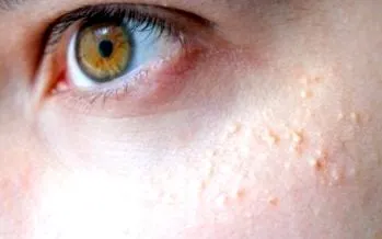 keratosis