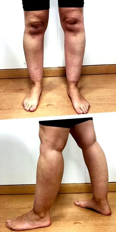 lipedema