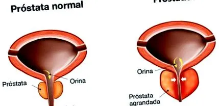 prostatitis