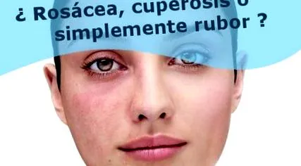 rosacea