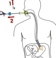 Danis implantációs
