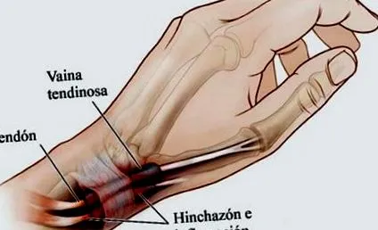 gyulladása