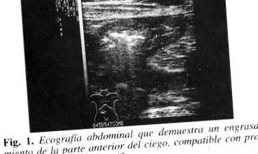 ulcer