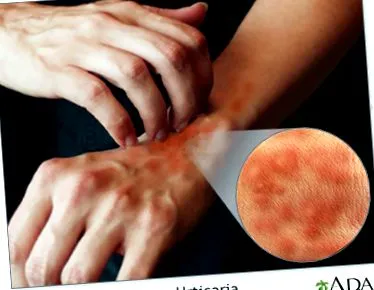 urticaria