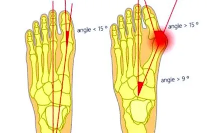 bunion