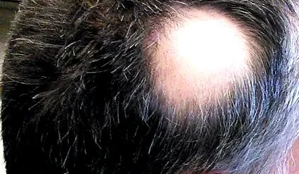 alopecia