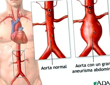 aneurizma