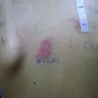 гастродуоденіт животі нудота