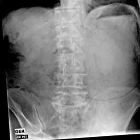 gastritis