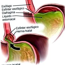 hiatal