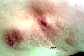 hidradenitis