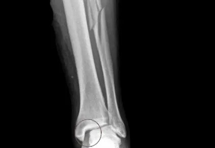fibula