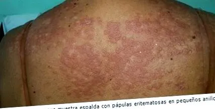 granuloma