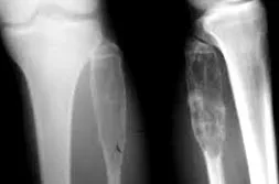 fibroma