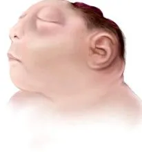 аненцефалията