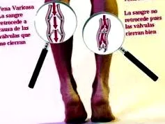vénás reflux