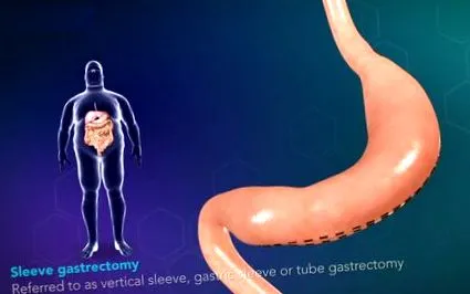 gyomorhüvely