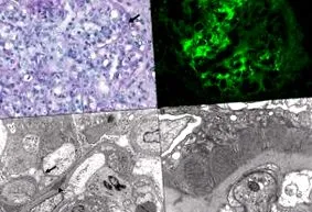 membranoproliferatív