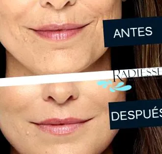 radiesse