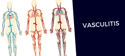 vasculitis