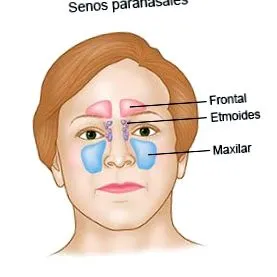 rhinosinusitis