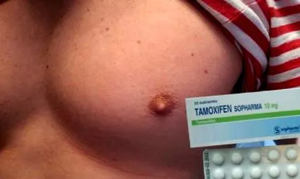 tamoxifen