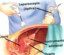 endometriózisról