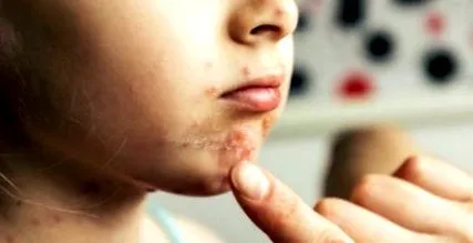 impetigo