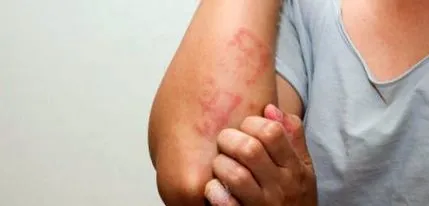 rosacea