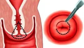 colului conization