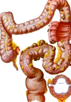 diverticulosis