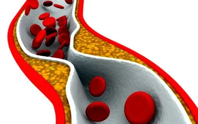 atherosclerosis