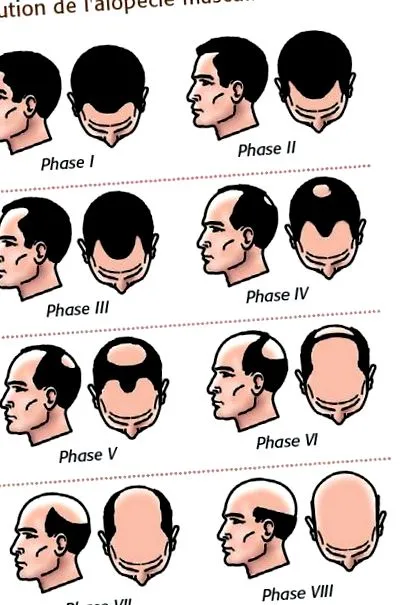 alopecia