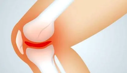 osteoarthritis