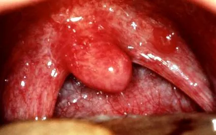 angina