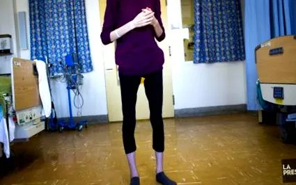 anorexia