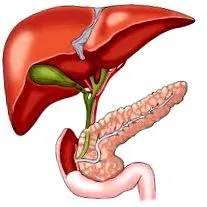 lithiasis