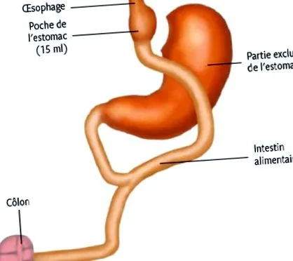 bariatrikus bariatrikus