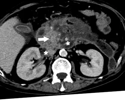 endoszkópos sphincterotomia