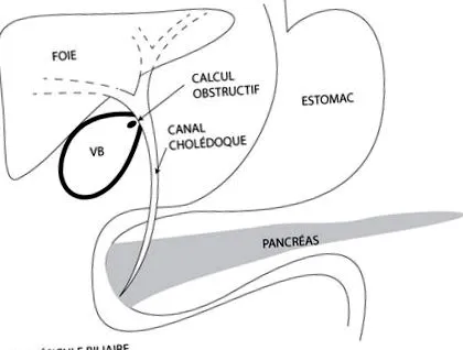 lithiasis