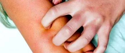cholangitis
